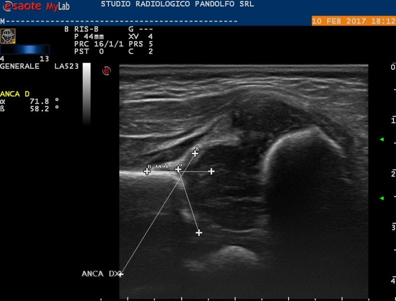 Ecografia Dell'anca Neonatale - Studio Radiologico Pandolfo ...