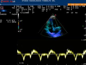 Ecocardiografia color-Doppler