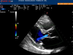 Ecocardiografia color-Doppler