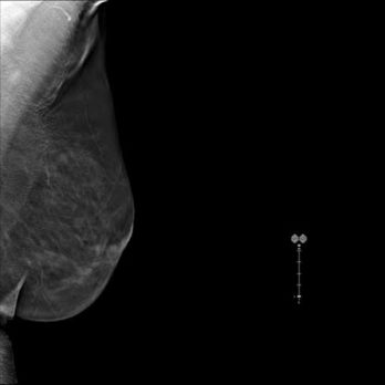 Tomosintesi Digitale Mammaria Studio Radiologico Pandolfo